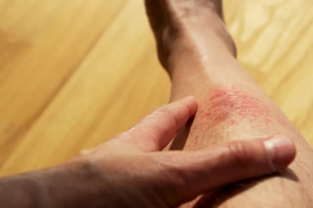 Uczulenie na buty objawy: jak rozpoznać i unikać alergii skórnych Uczulenie na buty objawy: jak rozpoznać i unikać alergii skórnych